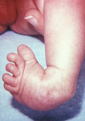 3 Condiciones ortopédicas en recién nacidos