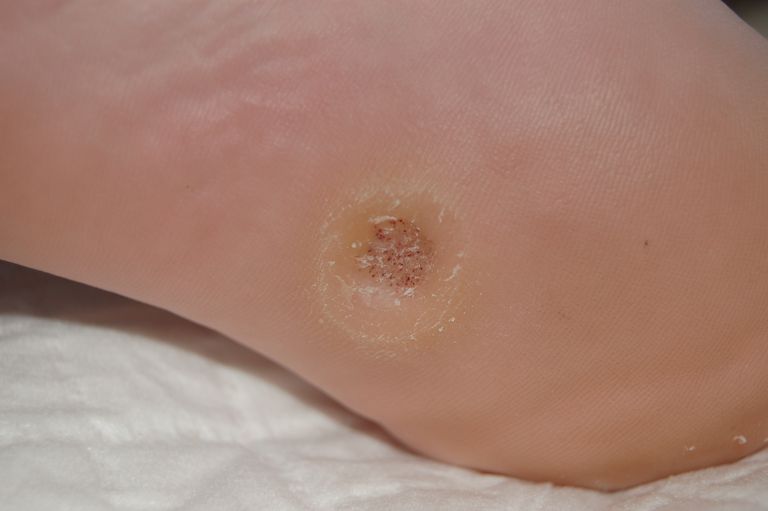 7 Problemas comunes de la piel de los pies