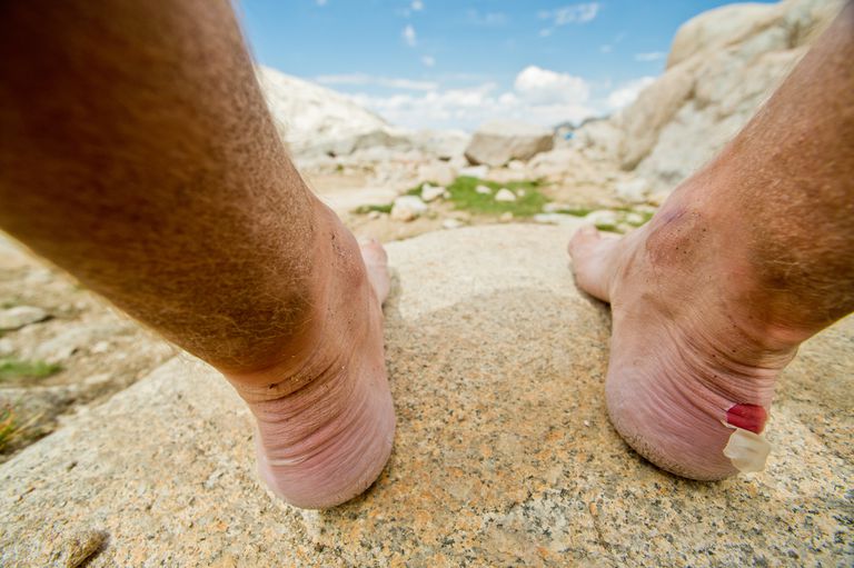 7 Problemas comunes de la piel de los pies