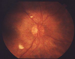 Todo sobre la retinopatía diabética