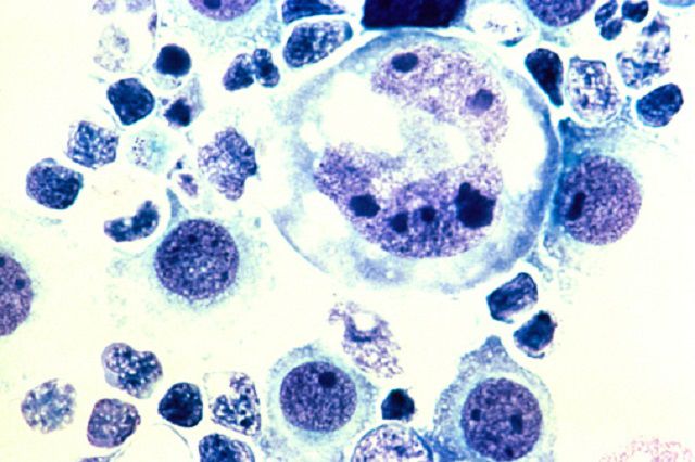 Linfoma anaplásico de células grandes (LACG)