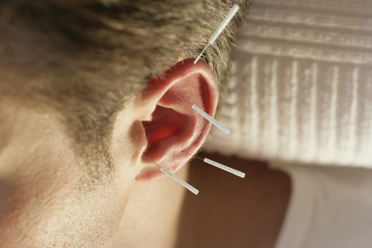 Los beneficios de la acupuntura del oído