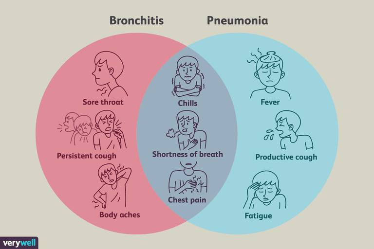 Bronquitis frente a neumonía: cómo diferenciar