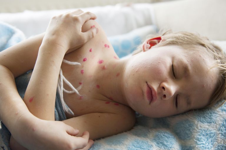 ¿Pueden los niños enfermarse con culebrilla?