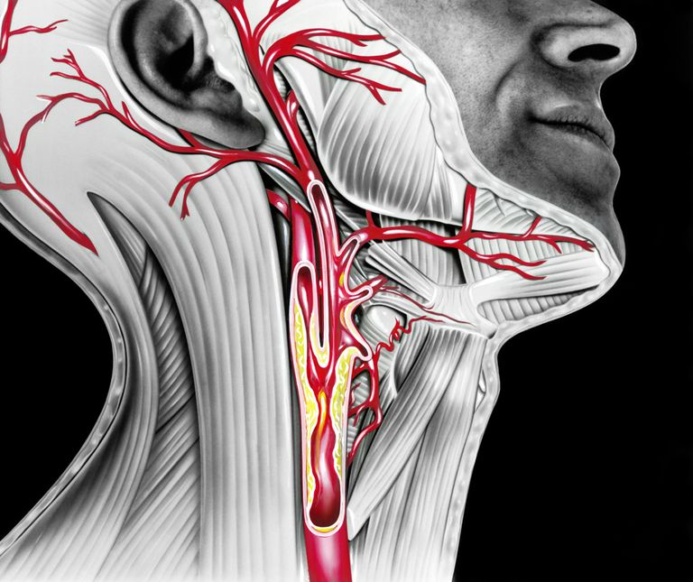 Cerebro y sistema nervioso s La estenosis carotídea es el estrechamiento de las arterias carótidas internas, las dos arterias grandes del cuello que proporcionan la mayor parte del suministro de sangre al cerebro.