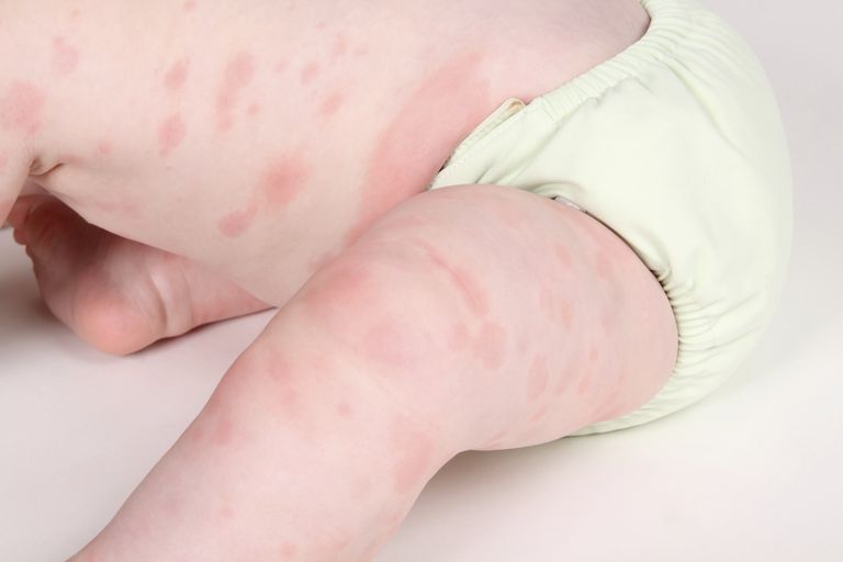 Niños y reacciones alérgicas a la penicilina
