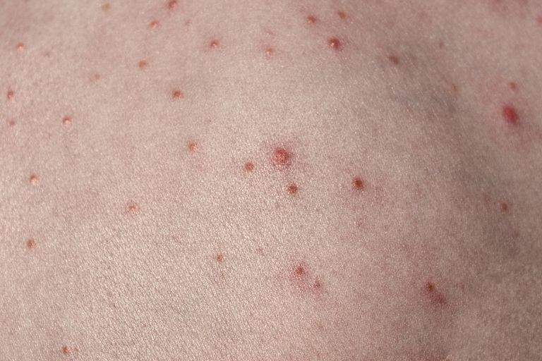 Infecciones bacterianas comunes de la piel