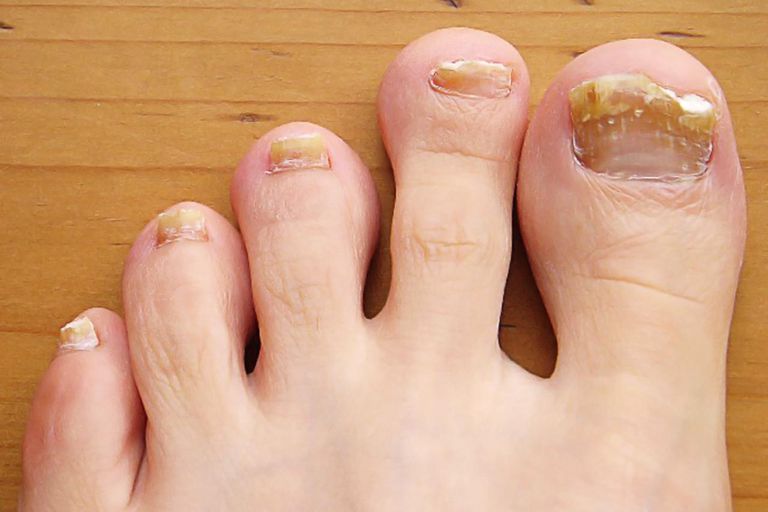 Síntomas comunes de las uñas de los pies, causas y tratamiento