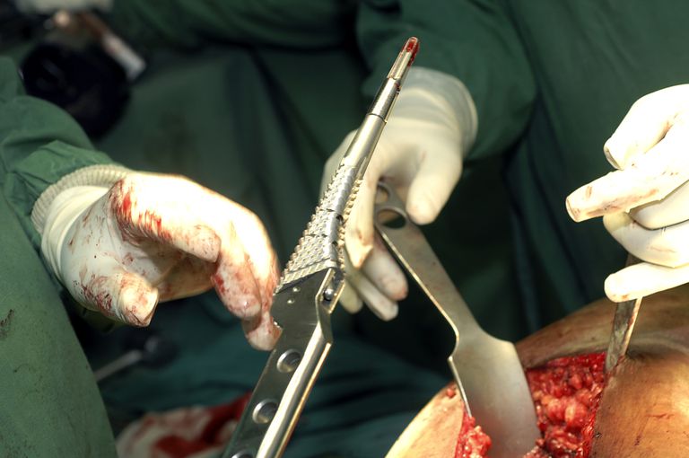 ¿Considera la cirugía de reemplazo de cadera?