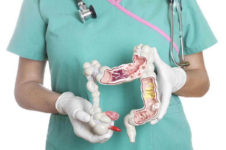 Colitis de Crohn en el intestino grueso