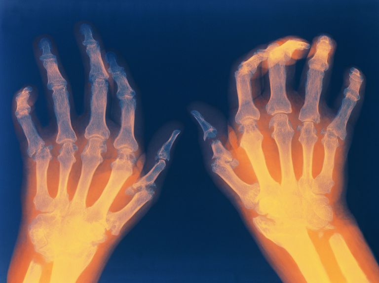 Cómo afecta la artritis reumatoide en cada parte del cuerpo