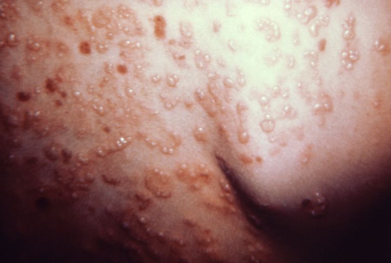 Dermatitis Herpetiforme Fotos