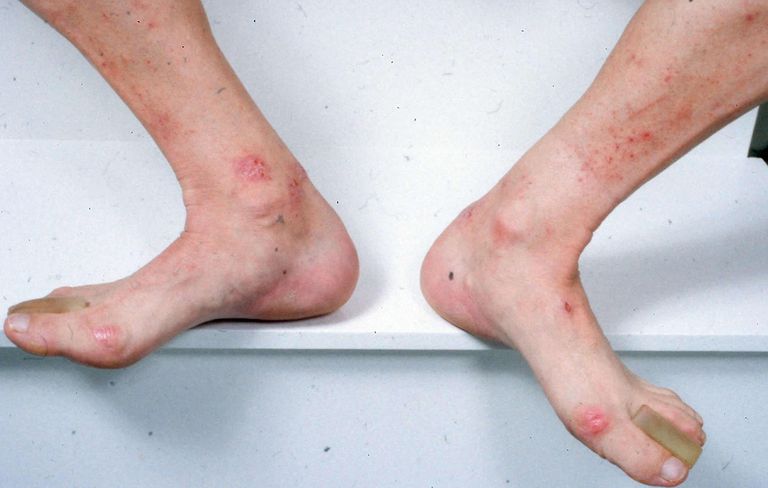 Dermatitis Herpetiforme Fotos