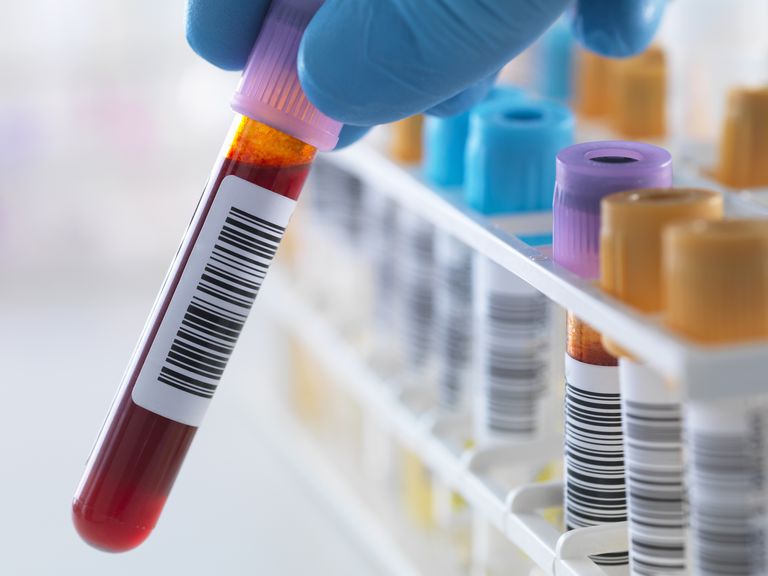 ¿Los resultados normales de la prueba de sangre descartan las enfermedades reumáticas?