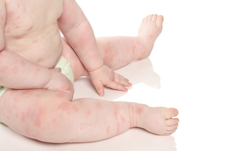 Desencadenadores de eczema y reacciones alérgicas en niños