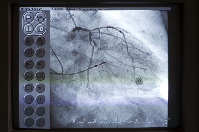 Explicación del cateterismo cardíaco y la angiografía