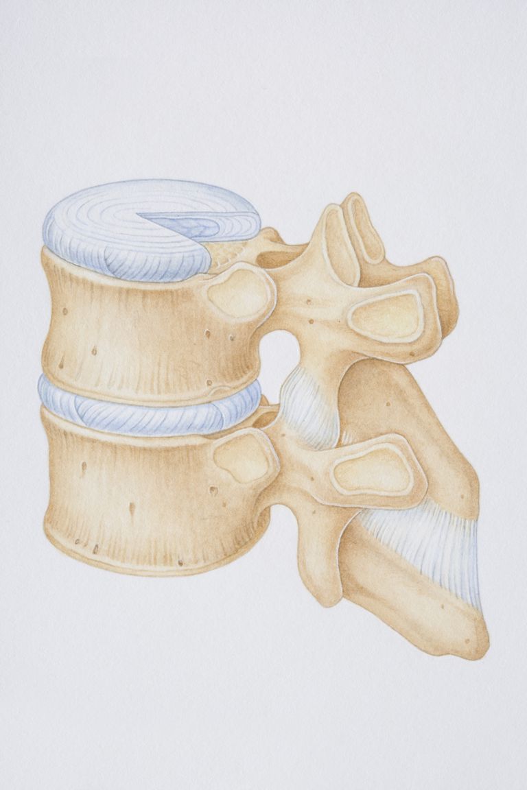 Cápsula articular facetaria y dolor de espalda