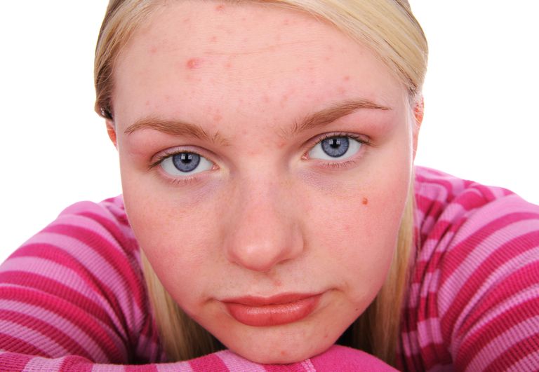 Cómo afecta el acné a su autoestima
