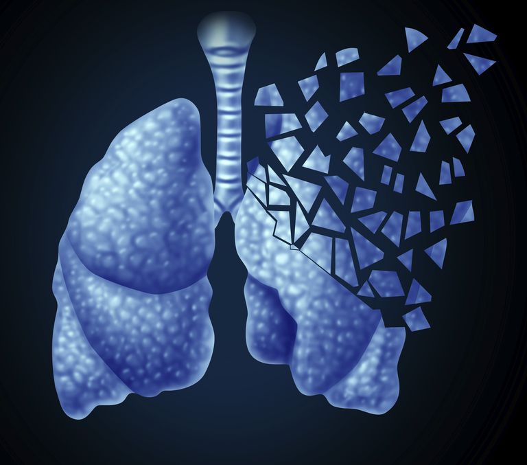 ¿Qué tan común es el cáncer de pulmón?
