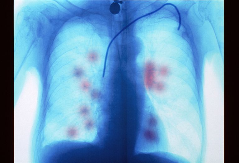 Cómo se diferencia el cáncer metastásico de los pulmones del cáncer de pulmón primario