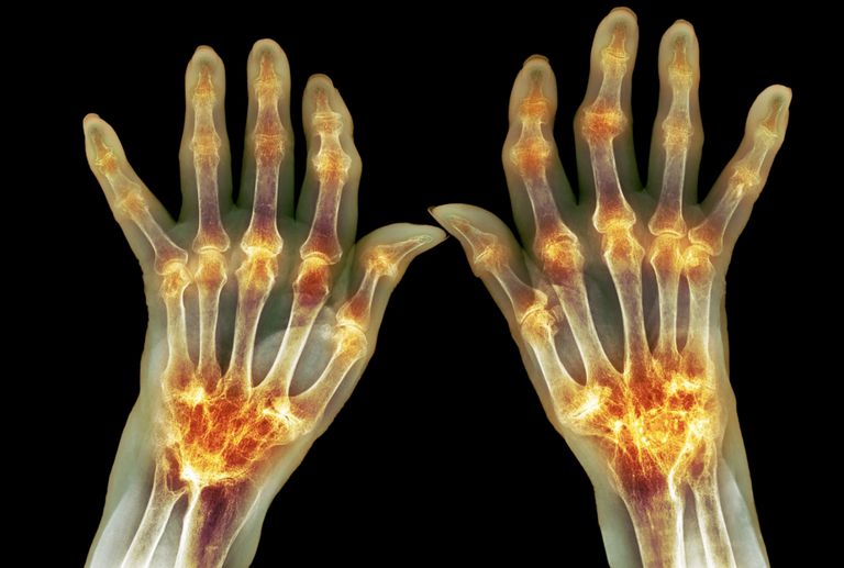 Cómo se desarrolla Pannus con artritis