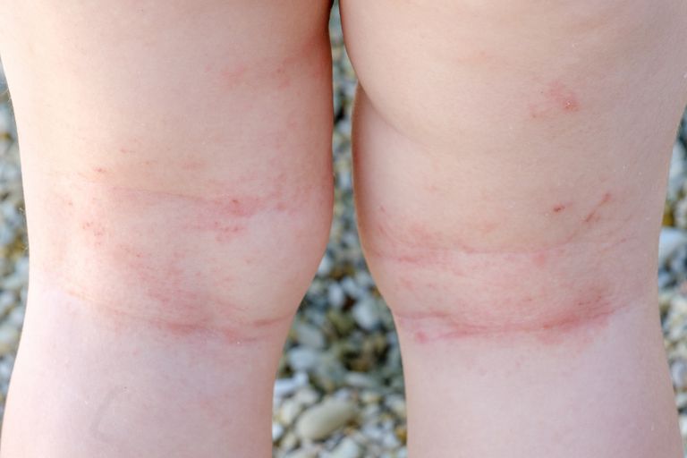 Cómo identificar el eczema en los niños