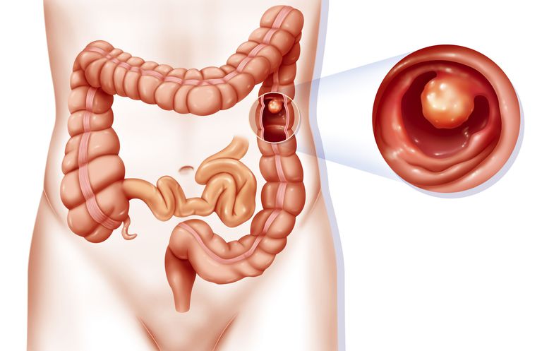 Identificar y tratar pólipos de colon