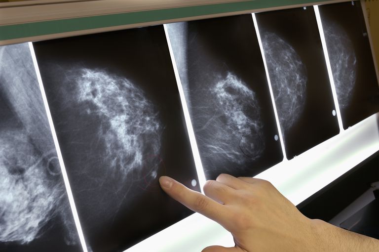 Datos importantes sobre los tumores del cáncer de mama