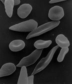 Información sobre anemia de células falciformes