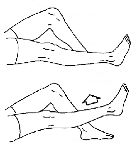 Ejercicios iniciales después de la artroscopia de rodilla