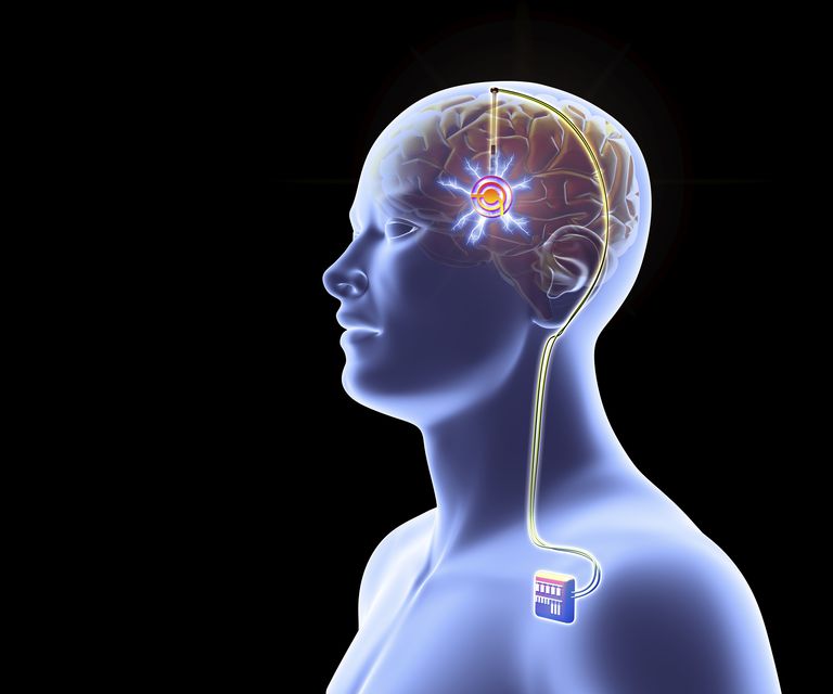 ¿La estimulación cerebral profunda es efectiva en el tratamiento del Alzheimer?