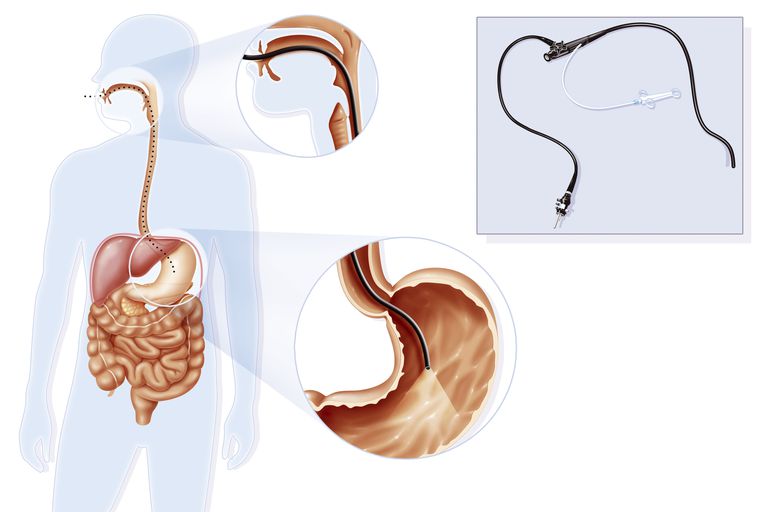 La enfermedad de Crohn puede afectar estas partes del tracto digestivo