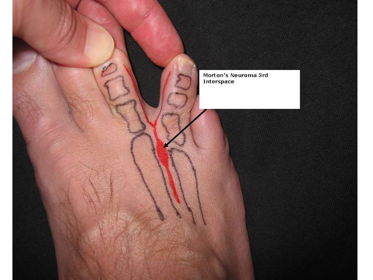 Neuroma de Morton: Causa común del dolor en el pie