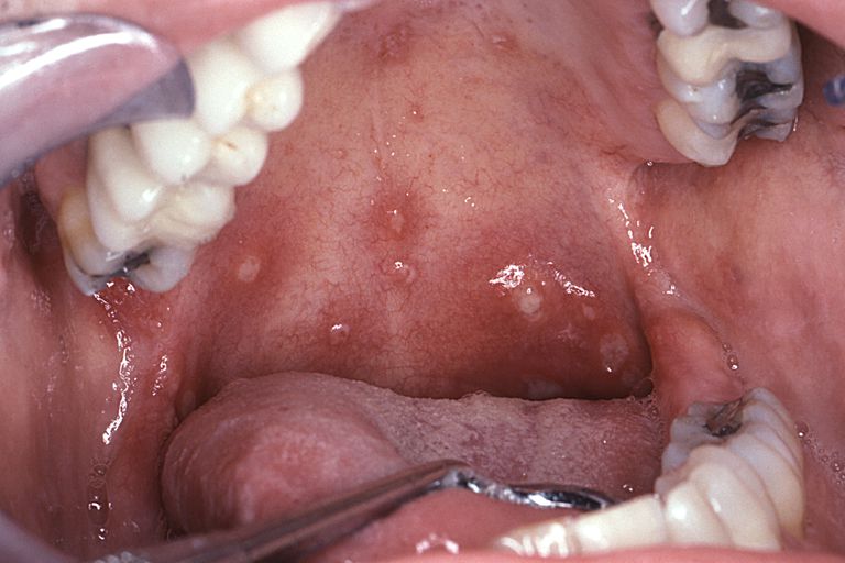 Muy confundido: diferencias entre el herpes labial, las úlceras bucales y los chancros