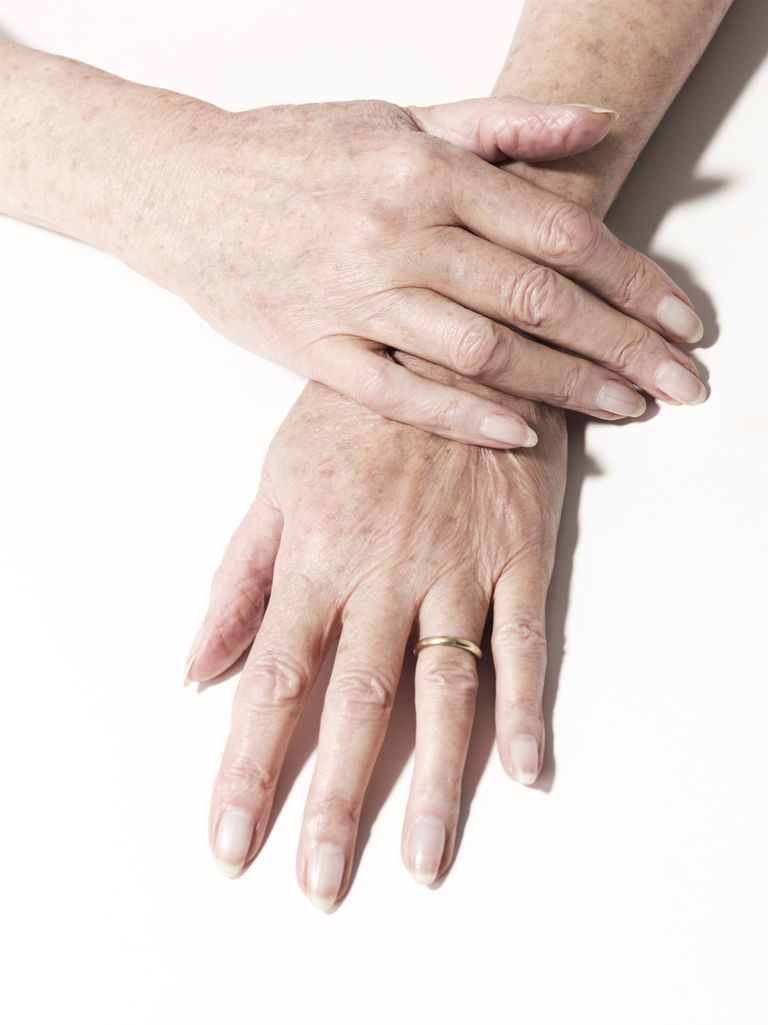 Problemas de uñas asociados con la psoriasis