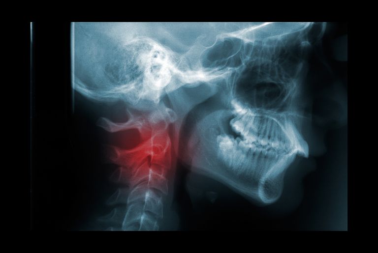 Lesión del cuello: una lista de los tipos más comunes