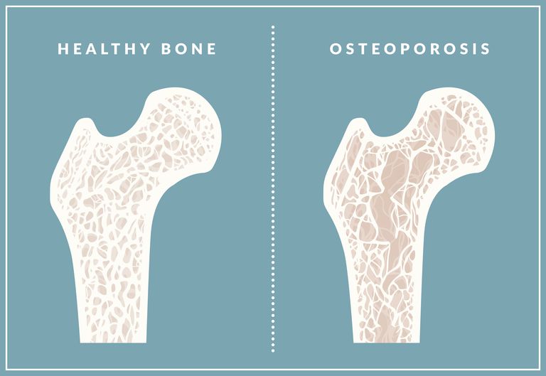 Tratamiento de osteoporosis: ¿es seguro tomar Fosamax?