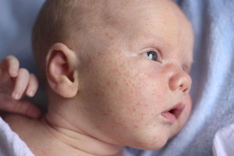 Una guía para padres sobre el acné del bebé recién nacido