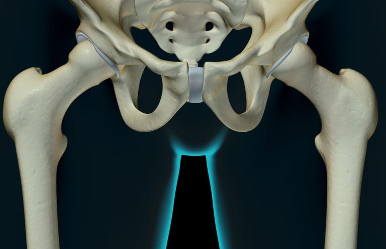 Ortopedia dys Displasia de cadera es el nombre médico utilizado para describir un problema con la formación de la articulación de la cadera en los niños. La ubicación del problema puede ser la bola de la articulación de la cadera (cabeza femoral), el alvéolo de la articulación de la cadera (el acetábulo) o ambos.