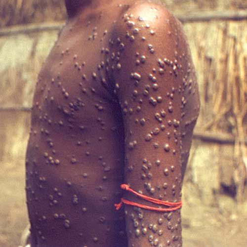 Imágenes de infecciones de la piel