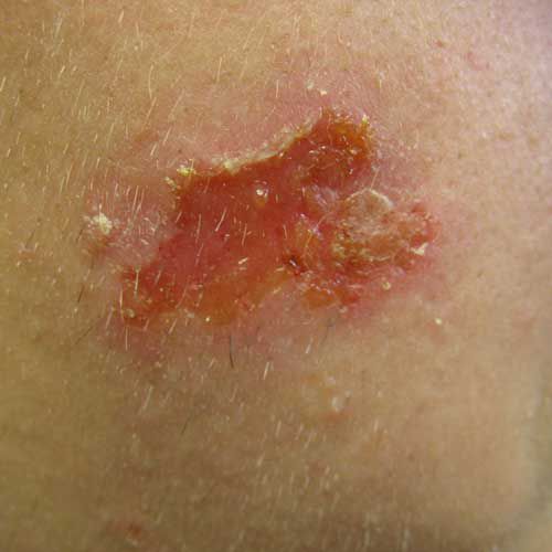 Imágenes de infecciones de la piel