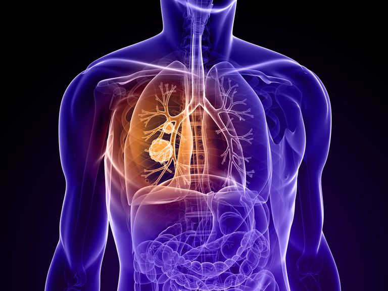 Causas posibles de una masa pulmonar