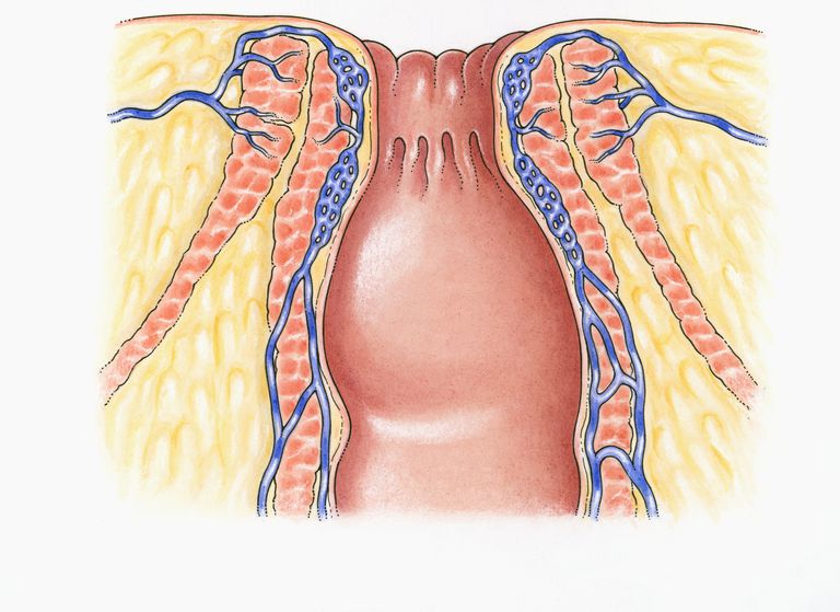 Cirugía de proctectomía para la enfermedad inflamatoria intestinal