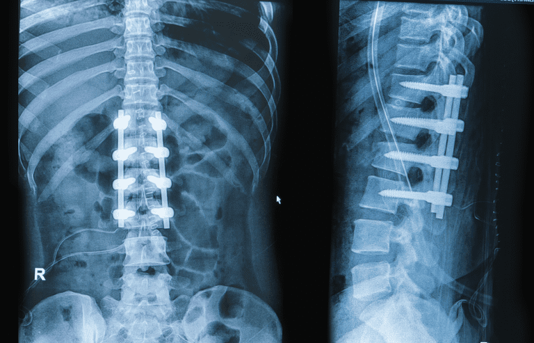 Razones para la cirugía de revisión de la columna vertebral