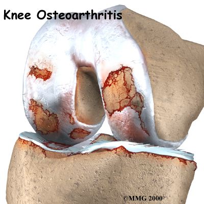 Tratamientos recomendados para la osteoartritis de la rodilla