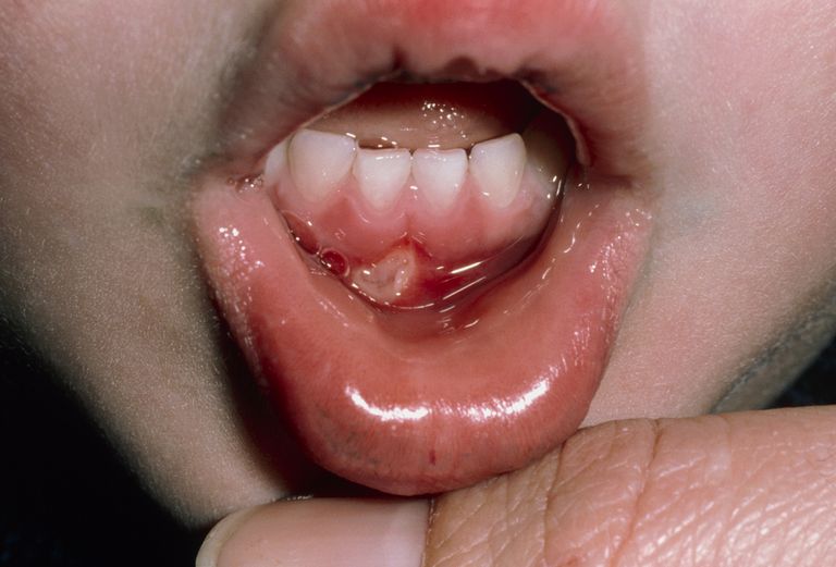 ÚLceras bucales recurrentes y úlceras bucales