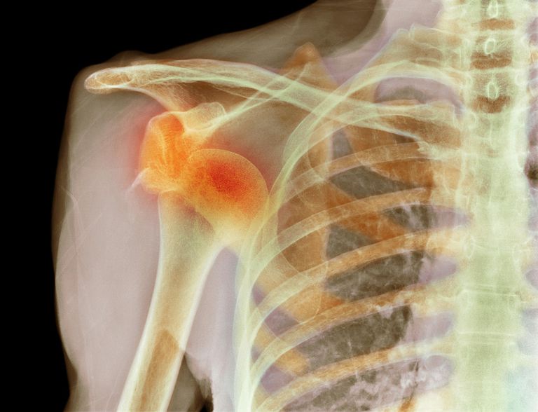 Síntomas y tratamiento de la dislocación del hombro