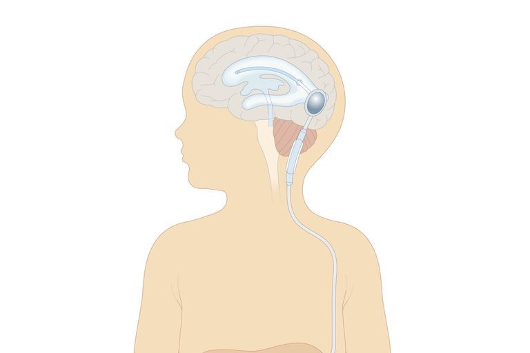 Colocación del shunt para la hidrocefalia
