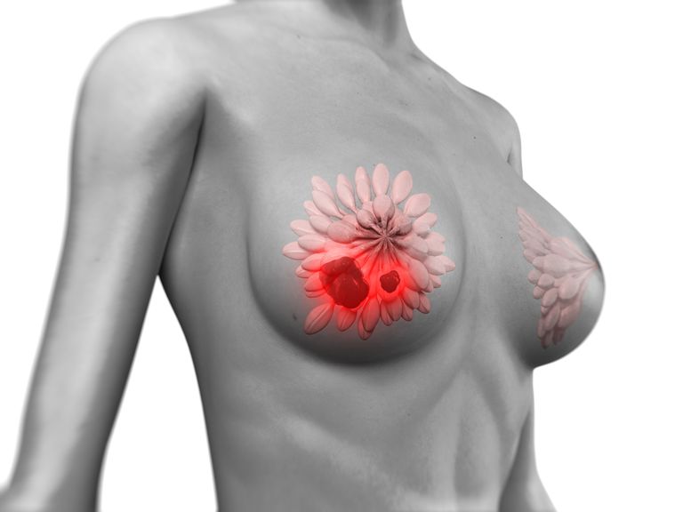 Importancia de las cicatrices radiales: una anomalía mamaria