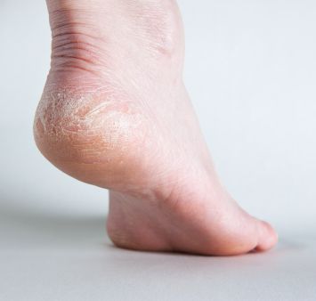 Condiciones de la piel que le provocan picazón en los pies